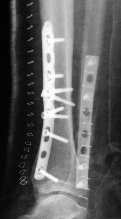 Tibia, Shaft:  Synthes Distal Tibial Plate (Implant 275)